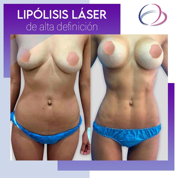 lipolisis_laser