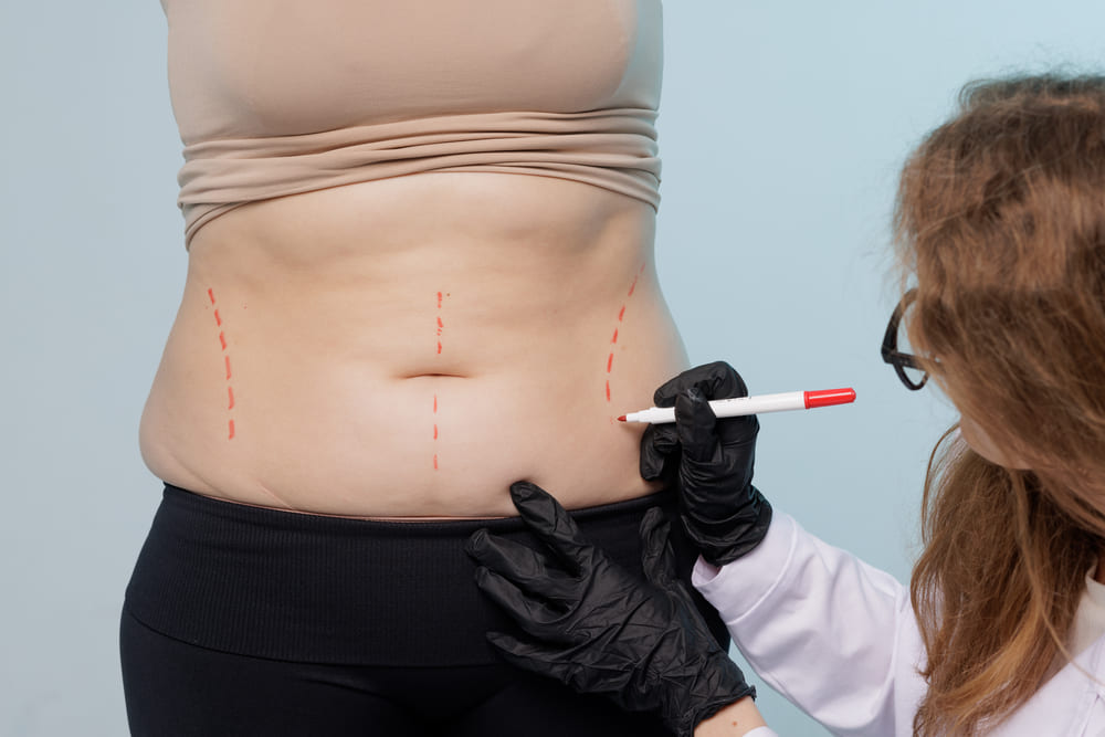 megalipólisis láser