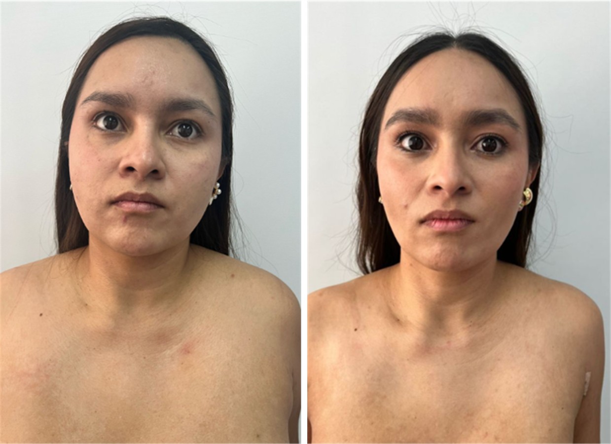 Laser facial endolifting: before and after of a clinic patient