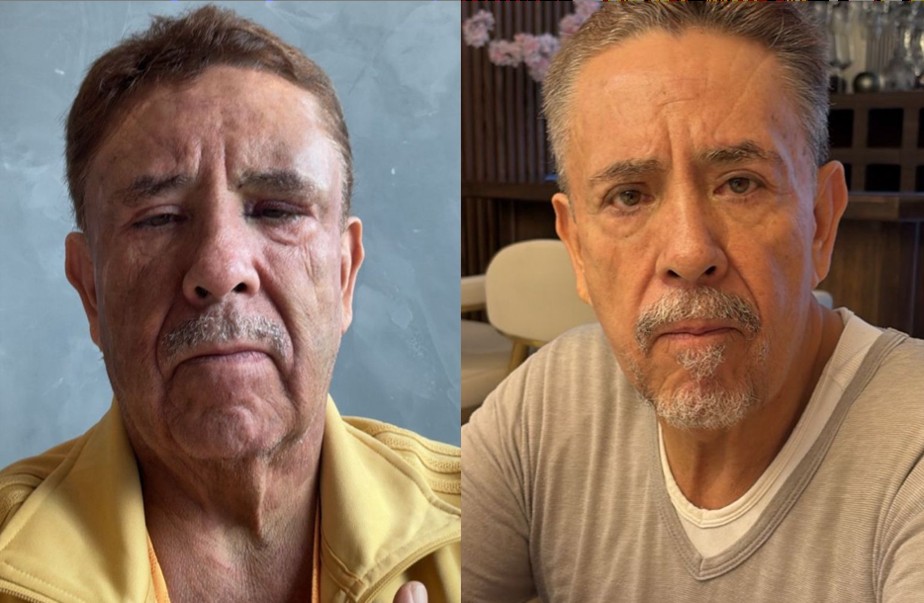 Endolifting facial láser: antes y después de un paciente