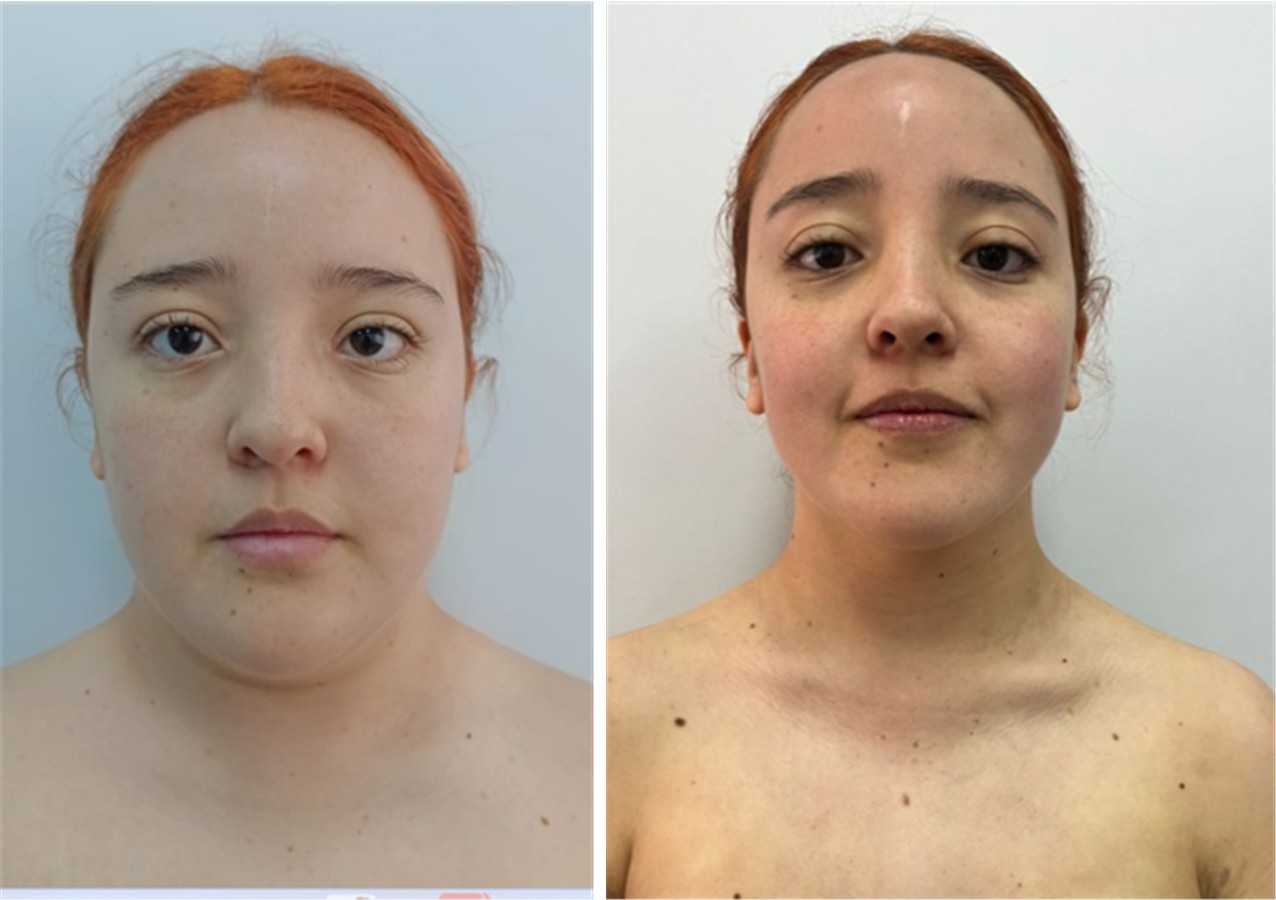Profileplasty: before and after of a patient's facial contour